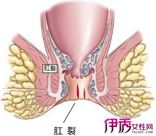 八个月宝宝肛裂图片，了解、预防与护理